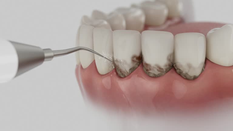 Trusted Wisdom Tooth Removal service in Mission Canyon, CA - Dentist Open Now